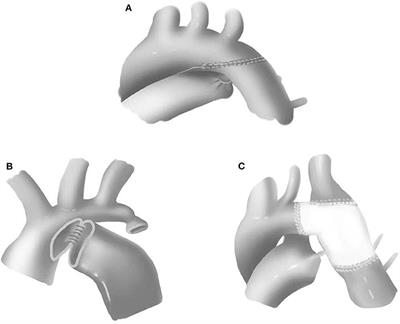 Diagnosis and Surgical Repair for Coarctation of the Aorta With Intracardiac Defects: A Single Center Experience Based on 93 Infants